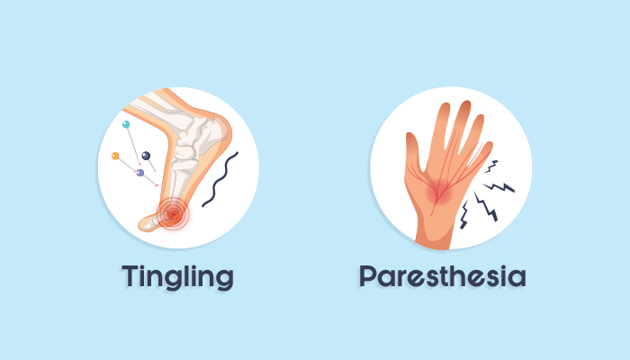 What is Tingling or Paresthesia
